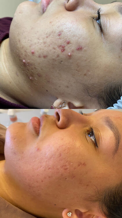 fotos de procedimentos curso personalizando peelings 2.0 cs academy (1)