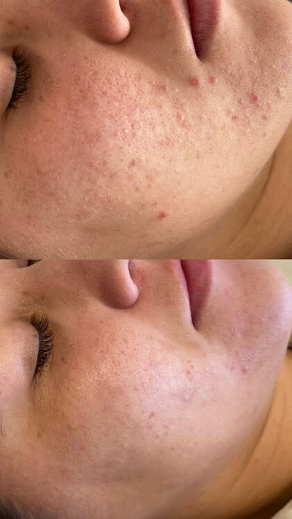 fotos de procedimentos curso personalizando peelings 2.0 cs academy (2)