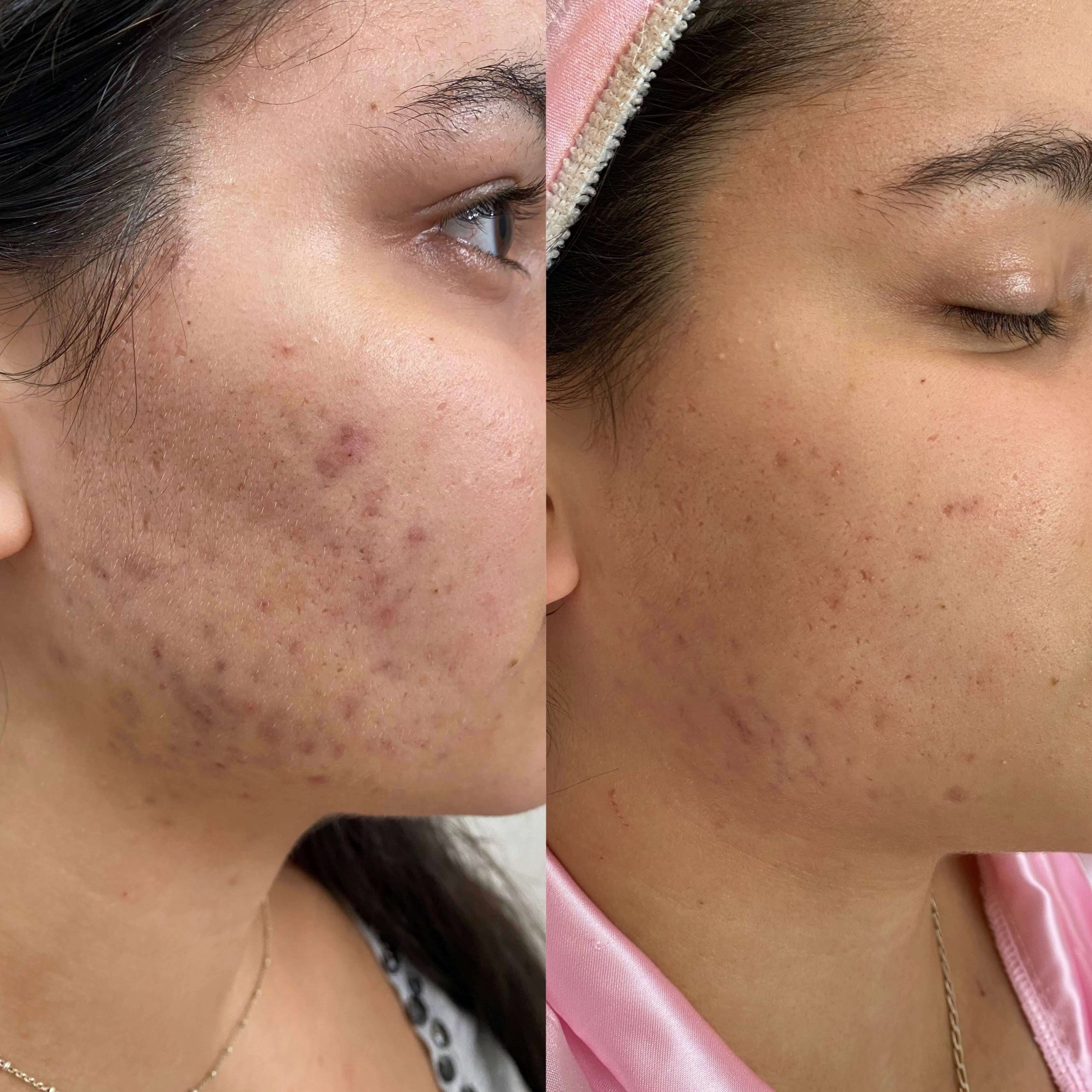 fotos de procedimentos curso personalizando peelings 2.0 cs academy (3)